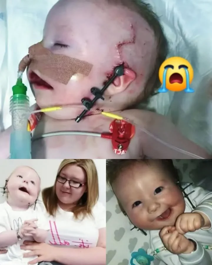 Elio, a toddler with a rare craniofacial condition, showcases his bravery and spirit.